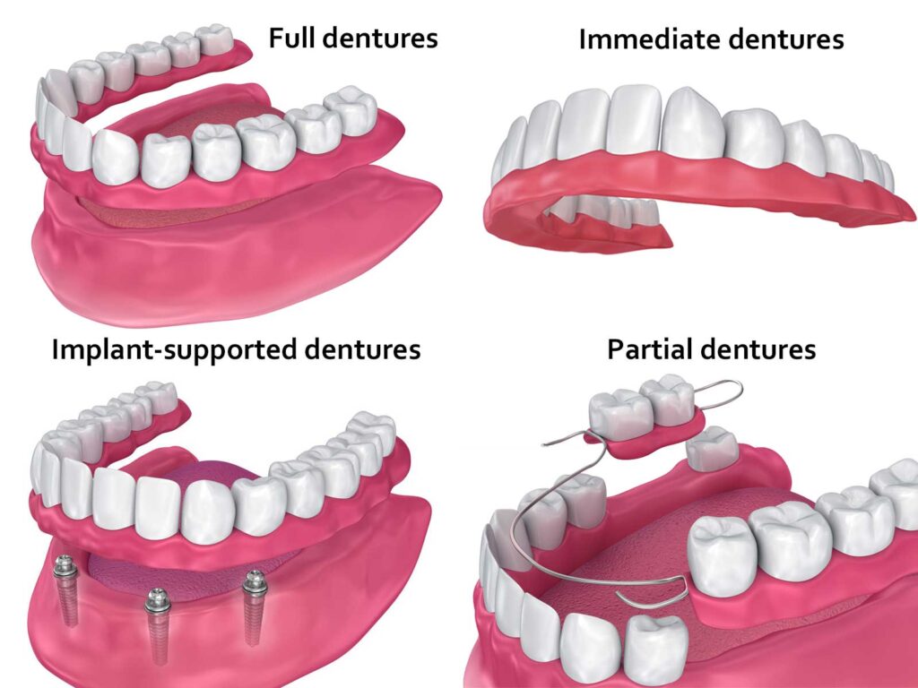 AllDentures