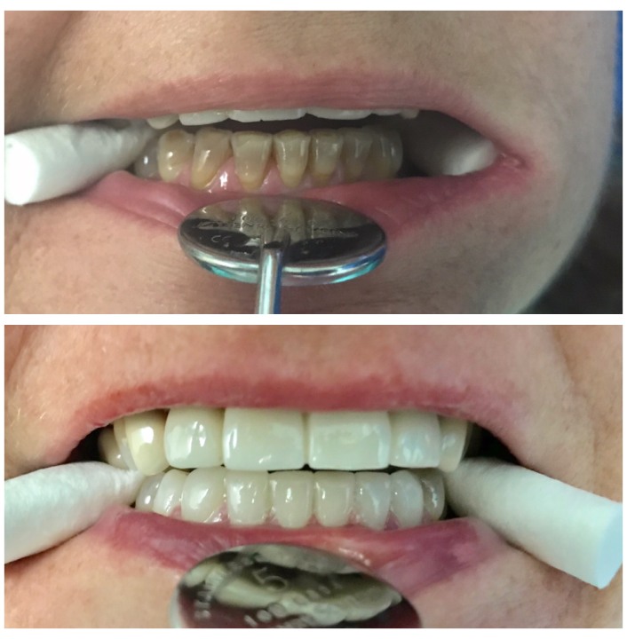 dental bridges img18
