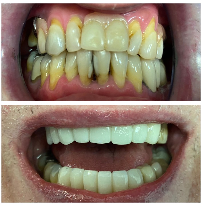 dental bridges img21