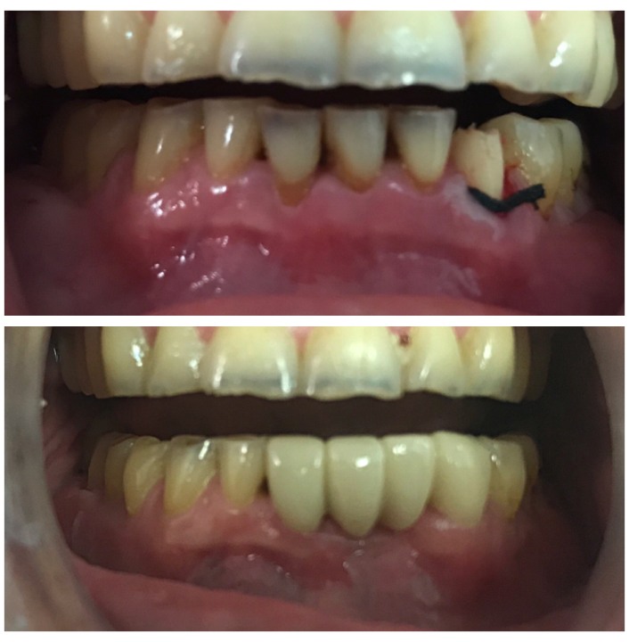dental bridges img22