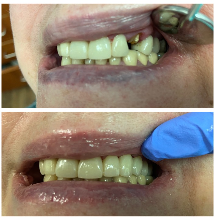 dental bridges img26
