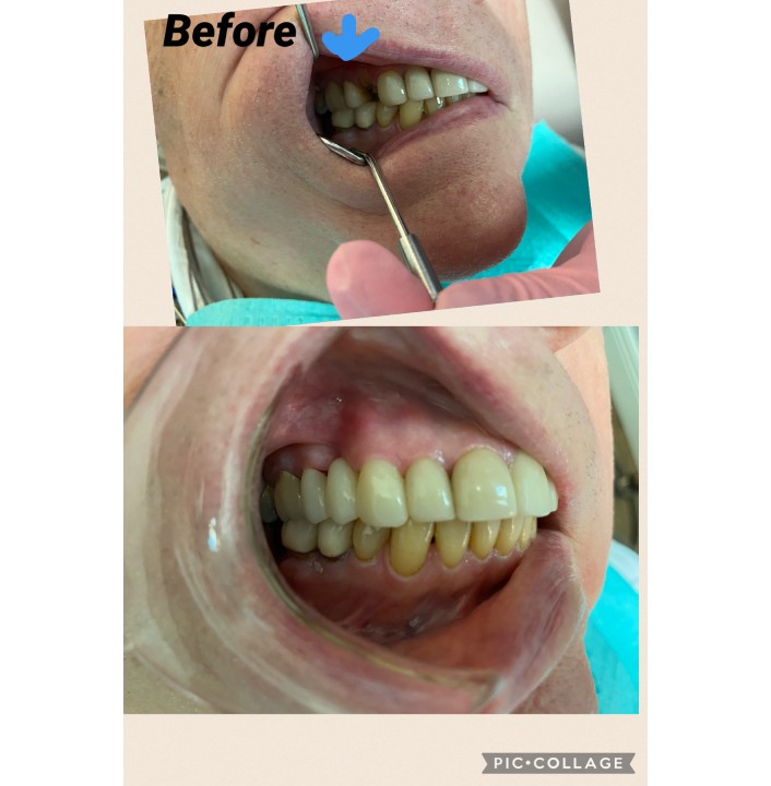 dental bridges img30