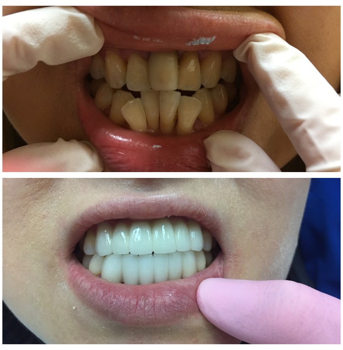 dental bridges img31