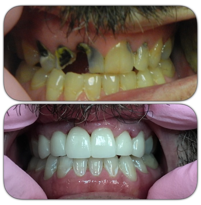 dental crowns img14