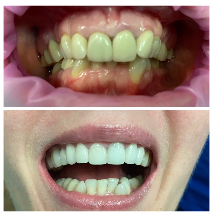 dental crowns img16