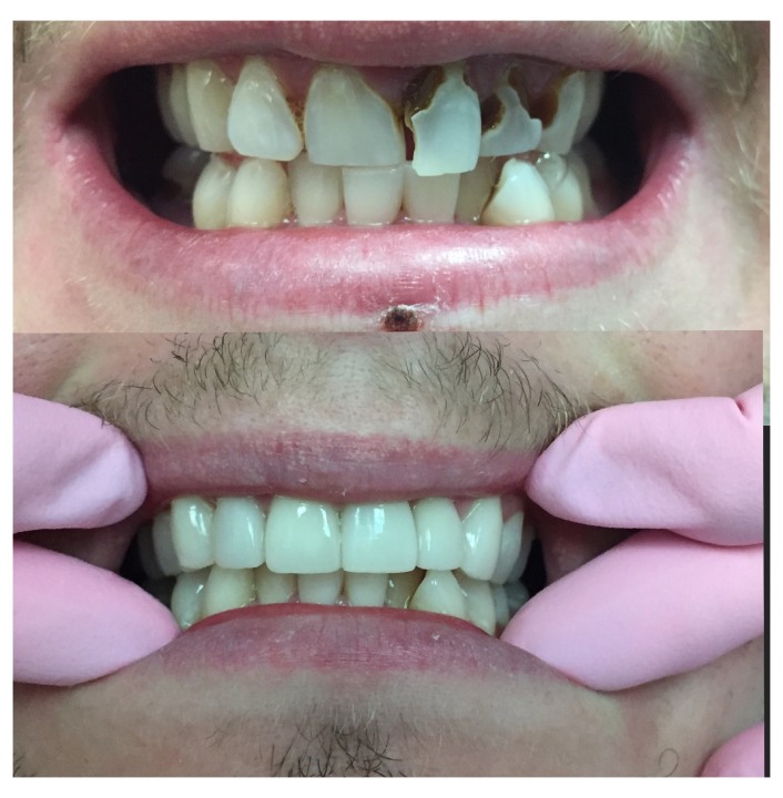 dental crowns img22