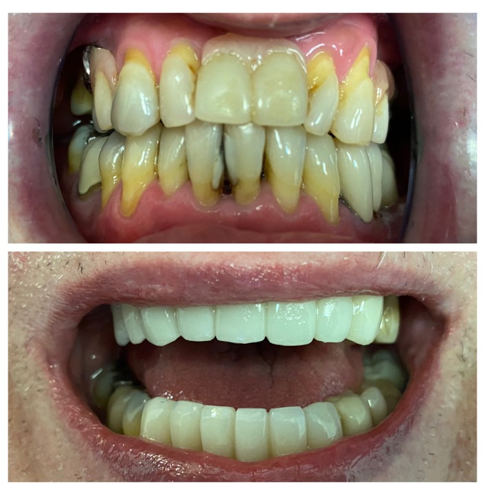 dental crowns img26