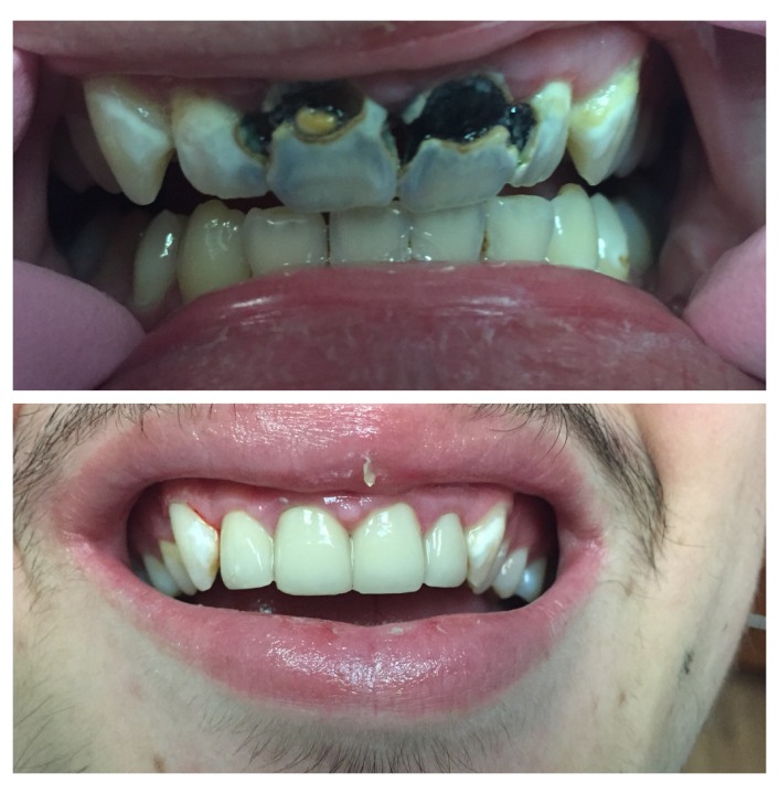 dental crowns img27