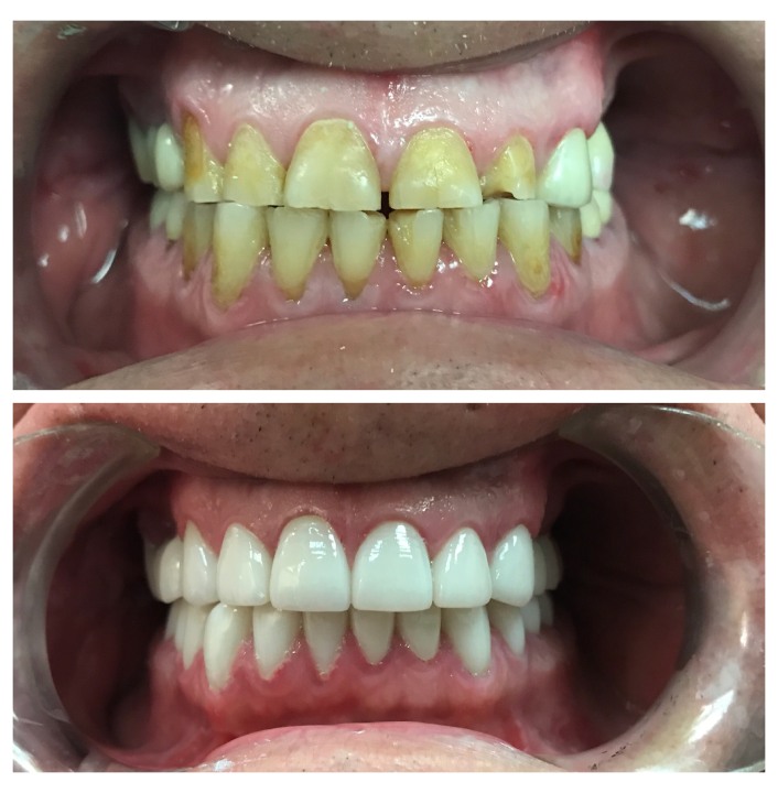 dental crowns img34