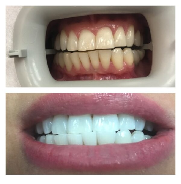 zoom teeth whitening aventura fl