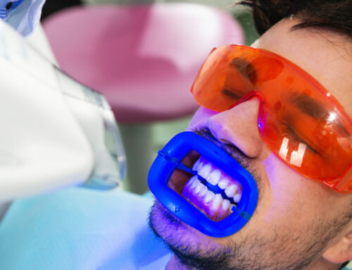 7 FAQs Regarding Zoom Professional Teeth Whitening