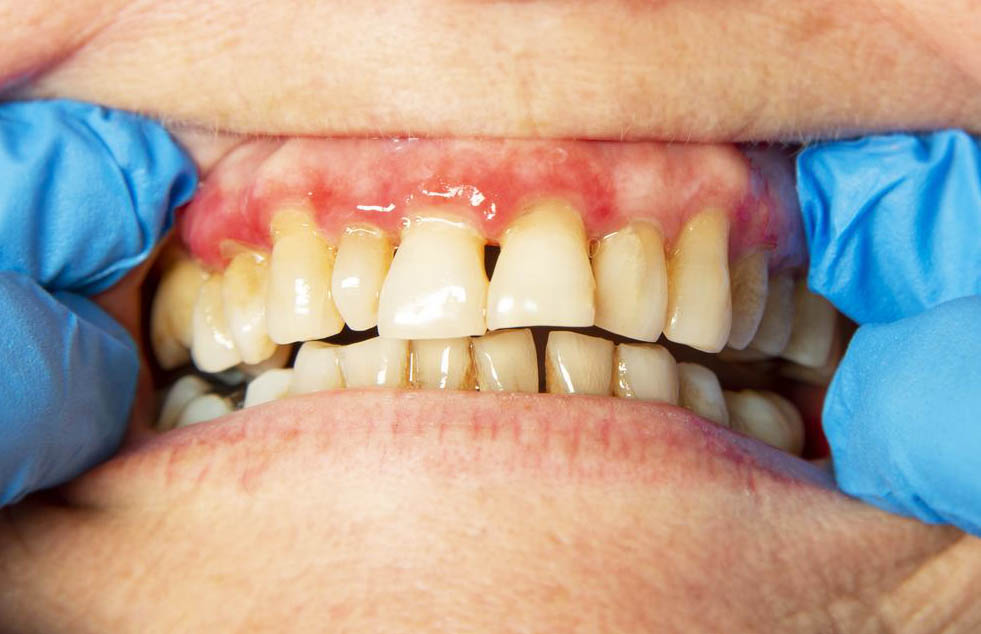 Periodontitis - Symptoms Causes & Prevention - Bright Horizons Dental