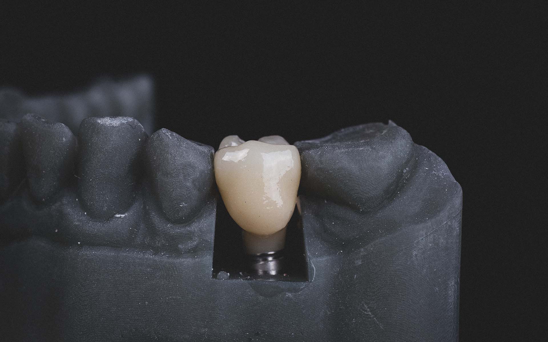 The Types & Benefits of Dental Bridges - Bright Horizons Dental