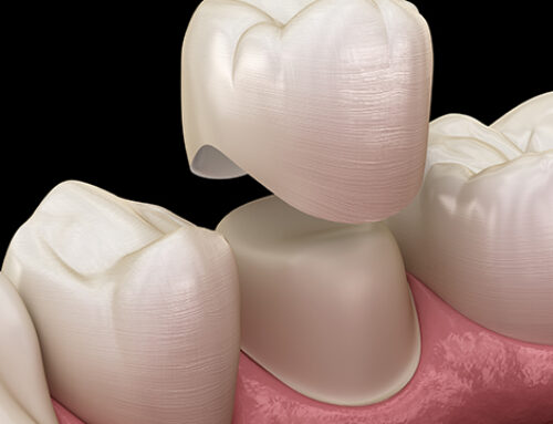 Decoding Dental Crowns: What You Need to Know