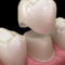Decoding Dental Crowns: What You Need to Know