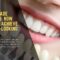 Tooth Shade Matching: How Dentists Achieve Natural-Looking Crowns