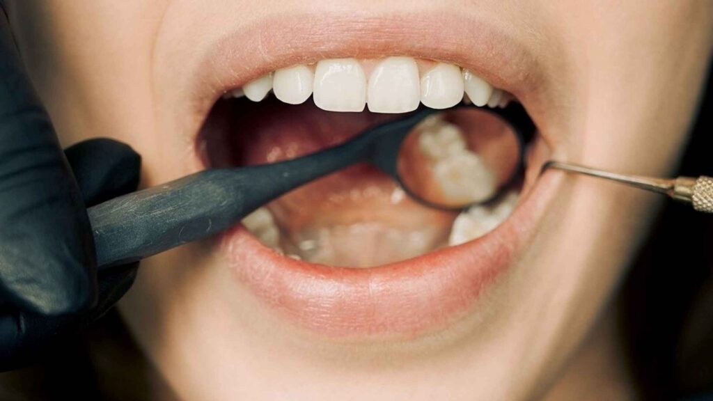 Preventing Oral Cancer Tips for a Healthier Mouth Preventing Oral Cancer Tips for a Healthier Mouth