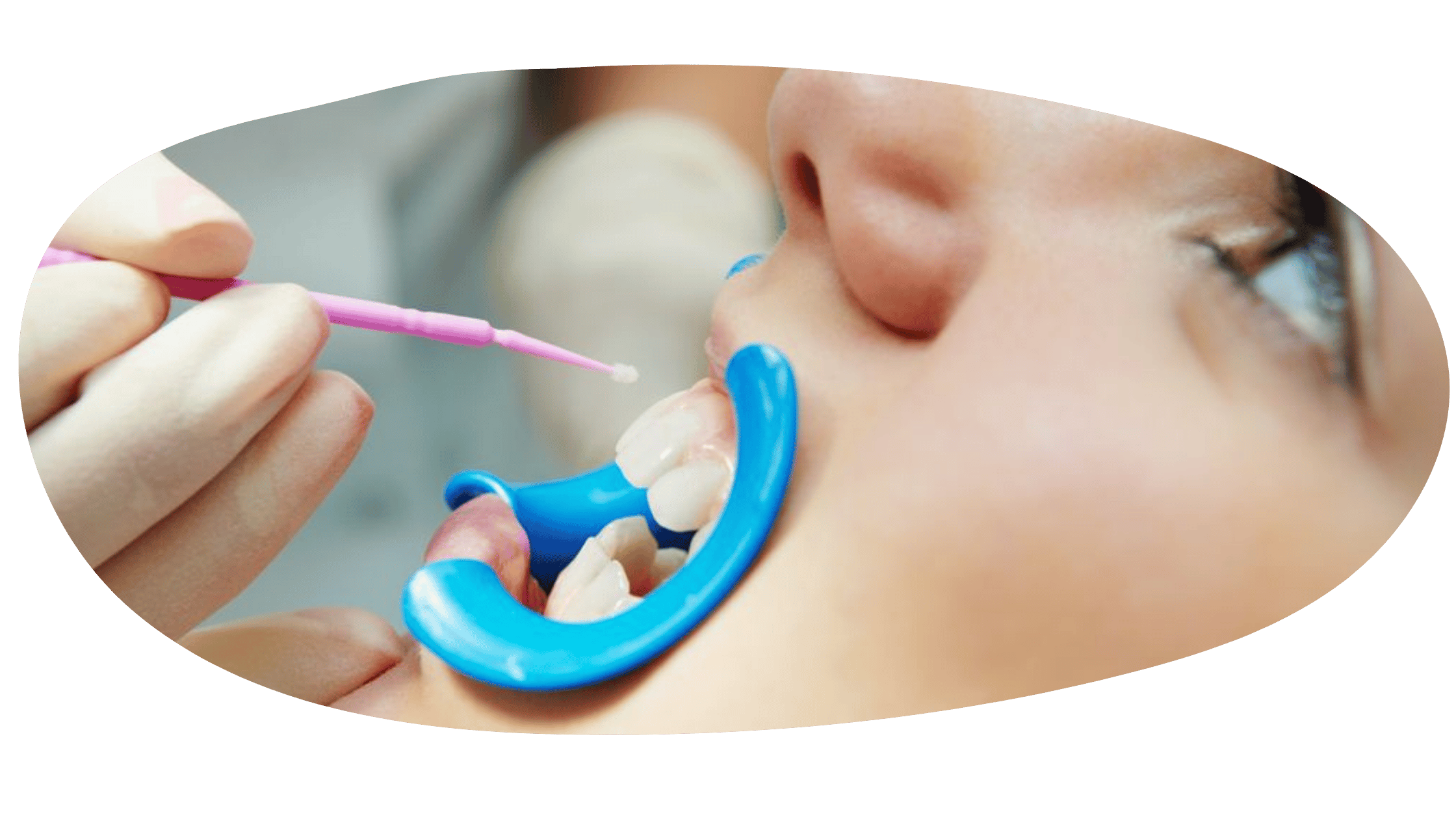 Dental Sealants for kids in Boca Raton