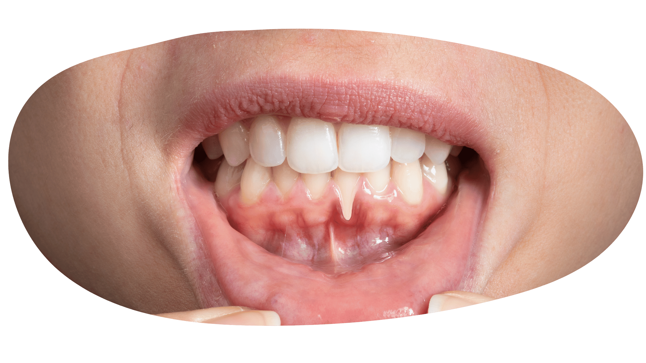 Gum Disease Treatment Gum Disease Treatment In Boca Raton, Fl