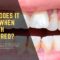 What Does It Mean When A Tooth Turns Red