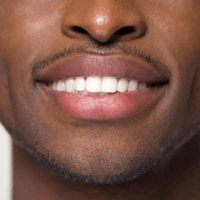 Dental Veneers In Boca Raton, Florida