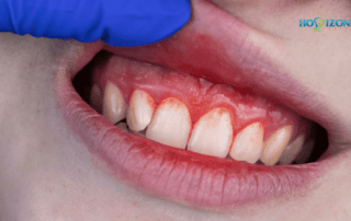 dentist lifting top lip to show irritated gums from gingivitis