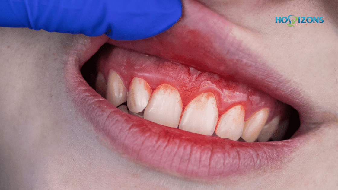 dentist lifting top lip to show irritated gums from gingivitis