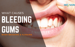 Woman lifting lip showing bleeding gums