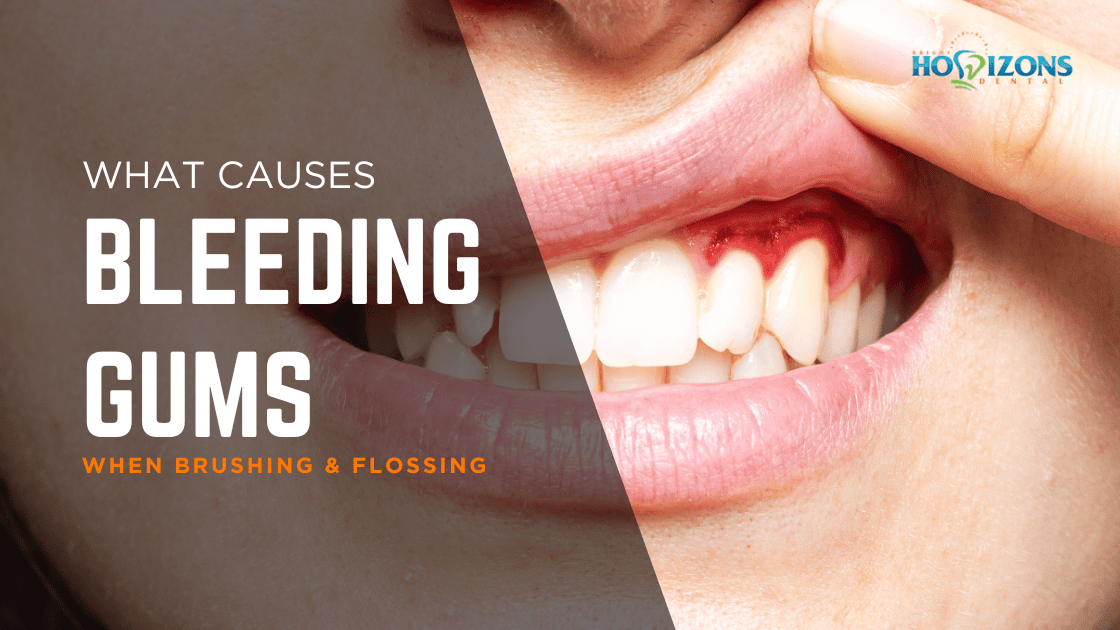 Woman lifting lip showing bleeding gums