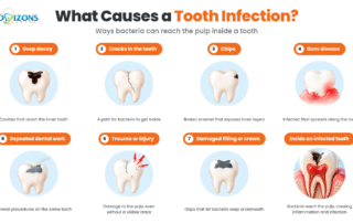 what-causes-a-tooth-infection