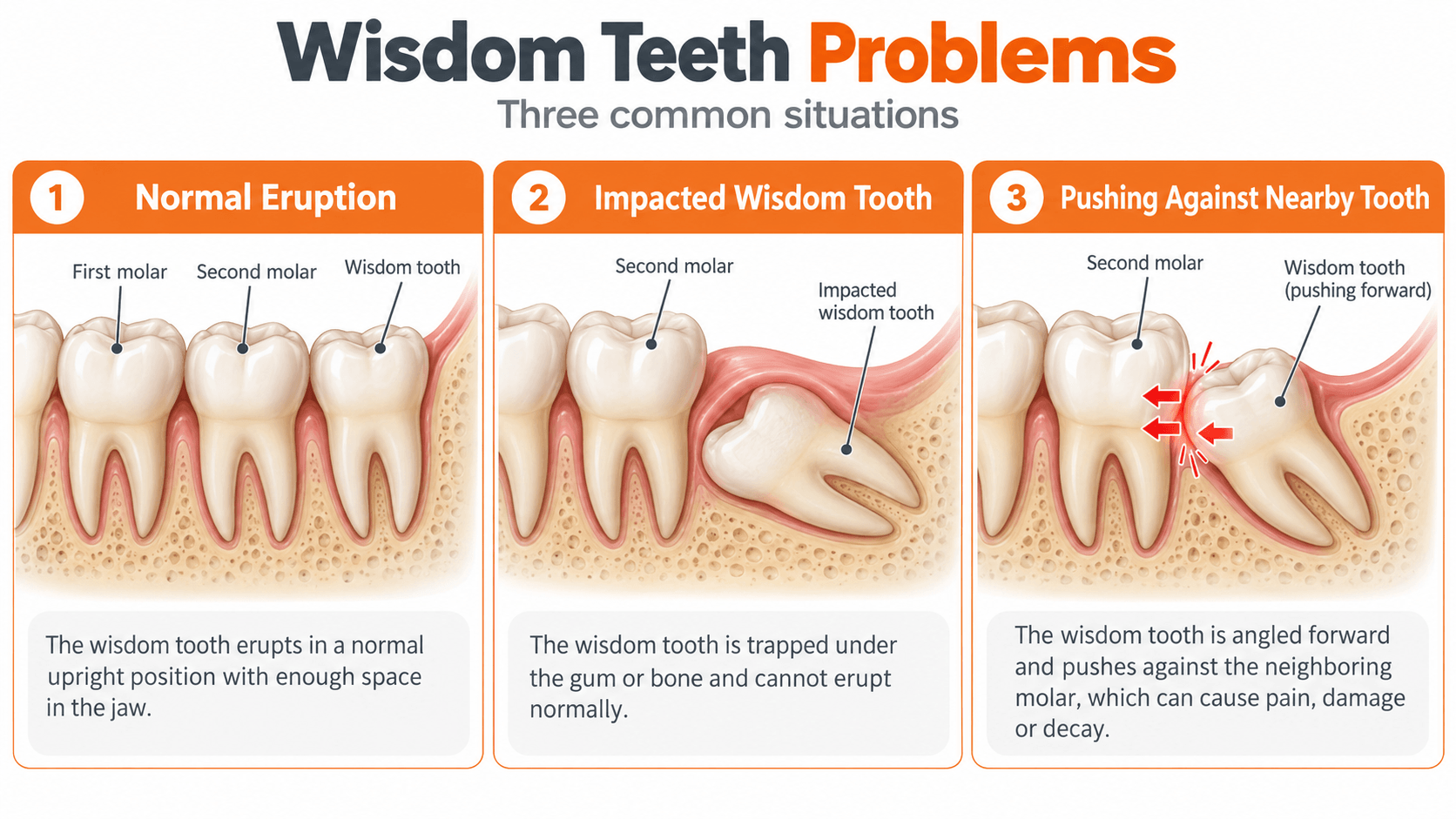 Wisdom tooth diagram showing normal eruption, an impacted wisdom tooth, and a tooth pushing against a nearby molar